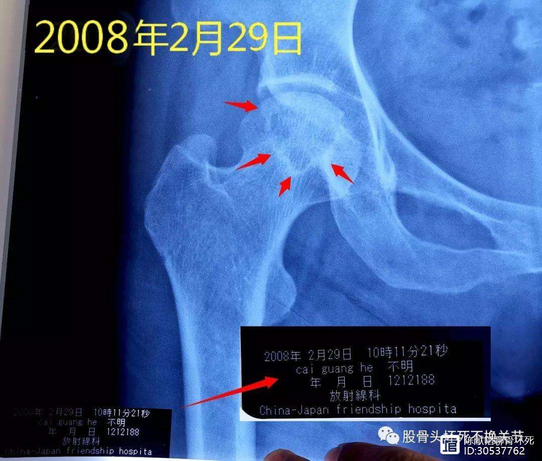 安顺人工骨头医保报销多少(人工骨头医保报销多少比例)